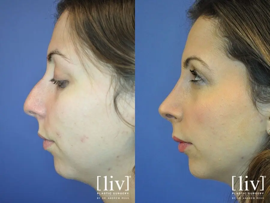 Before and After Rhinoplasty liv Plastic Surgery by Dr Andrew Ress Boca Raton